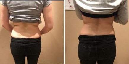 Before and after fat freezing